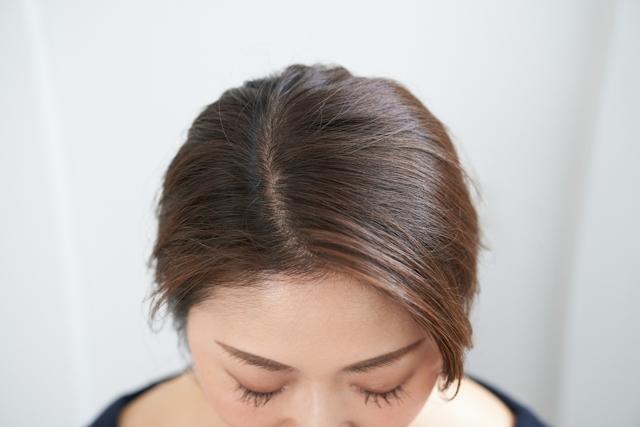 頭皮の赤みは放置すると抜け毛やかゆみを引き起こす 原因と対策について 女性の薄毛 抜け毛予防なら 髪のせんせいwomen Byスカルプdのアンファー
